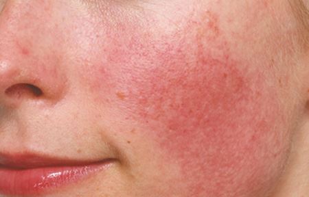 Acne rosacea: cause, sintomi, cura