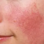 Acne rosacea: cause, sintomi, cura