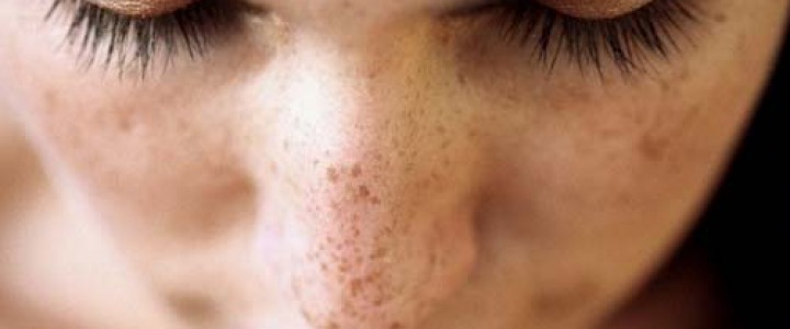 Macchie scure sul viso: laser per macchie solari