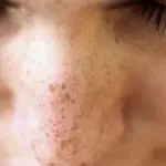 Macchie scure sul viso: laser per macchie solari