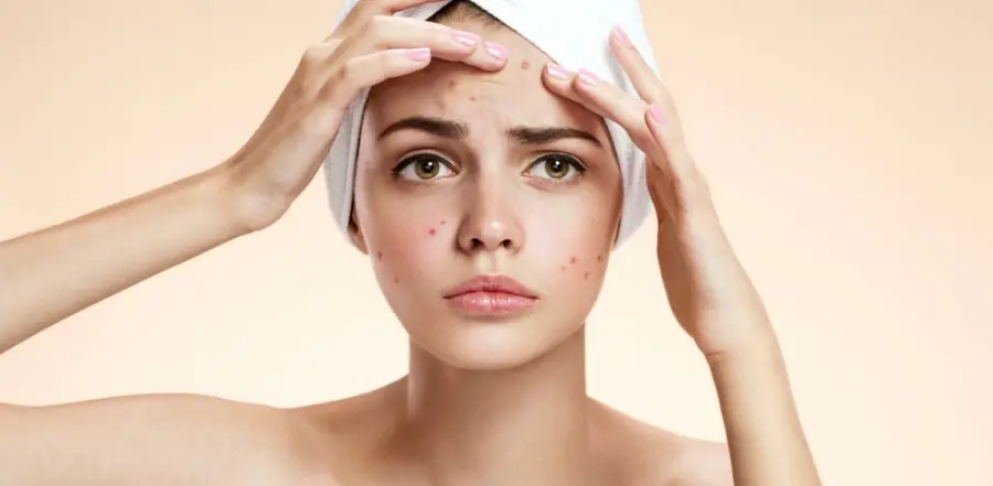 Acne giovanile: come si cura