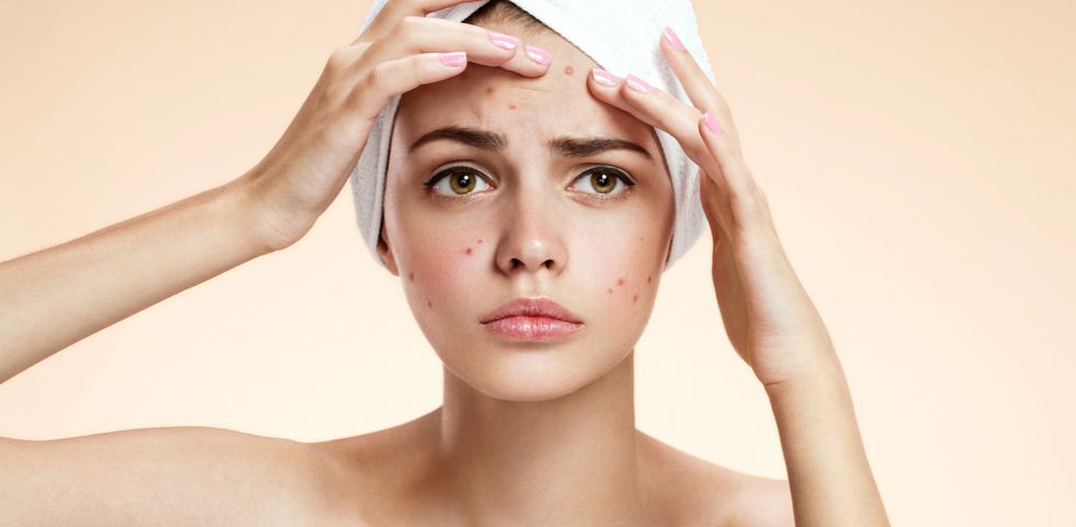 Acne giovanile: come si cura
