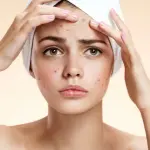 Acne giovanile: come si cura