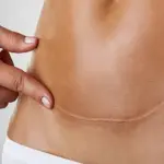 Cesareo: cicatrice ipertrofica o cheloide