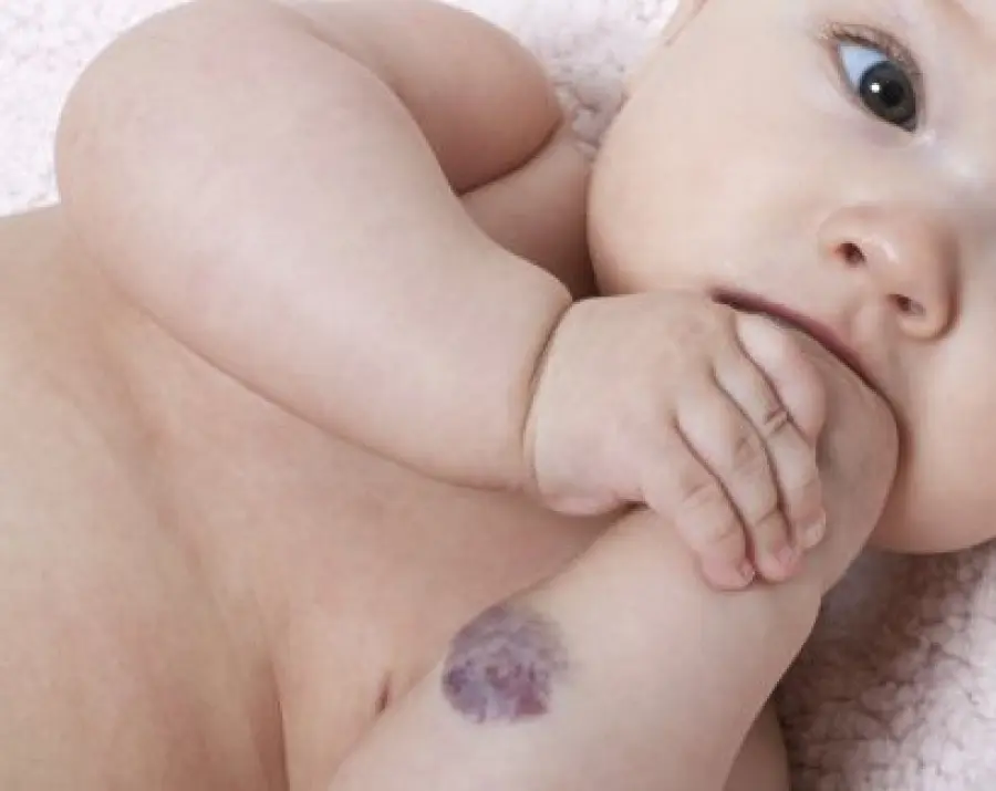 Macchie rosse sulla pelle nei bambini: angioma o capillari