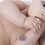 Macchie rosse sulla pelle nei bambini: angioma o capillari
