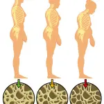 Osteoporosi: vitamina D, alimentazione, farmaci