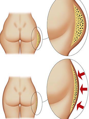 Cellulite in sovrappeso: pancia, cosce, glutei con cellulite