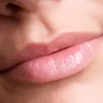Aumento labbra: con filler o permanente?