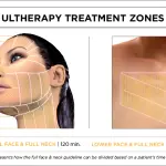 Lifting non chirurgico con ultrasuoni