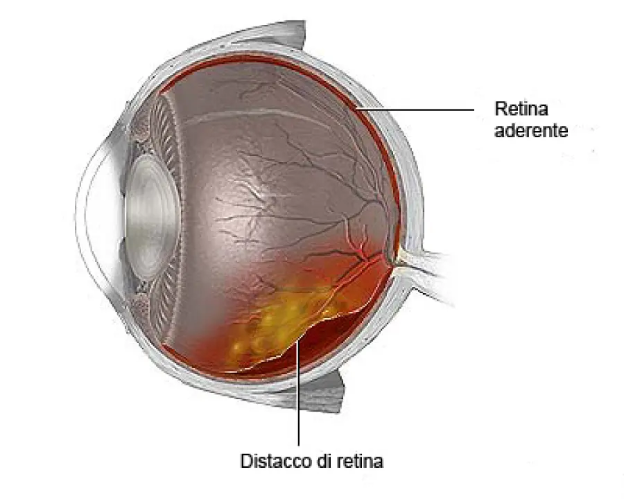 Maculopatia e distacco di retina: nuova cura