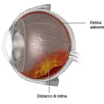Maculopatia e distacco di retina: nuova cura
