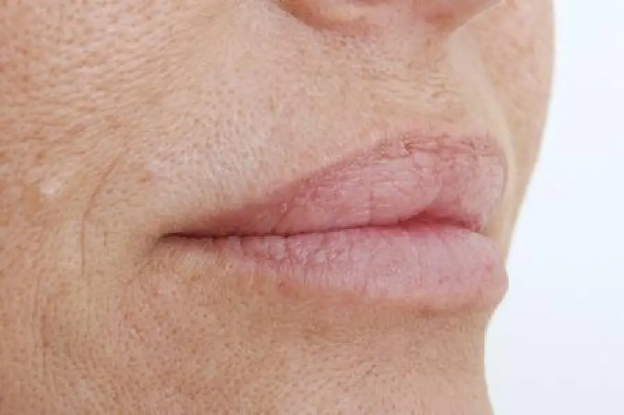 Pelle secca: rimedi naturali efficaci