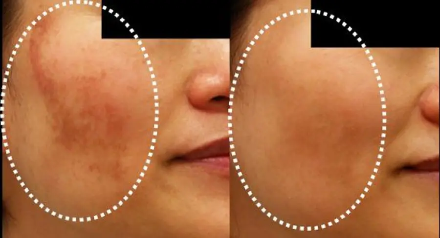 Come eliminare le macchie solari dal viso