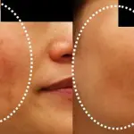 Come eliminare le macchie solari dal viso