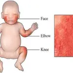 Dermatite atopica nei neonati