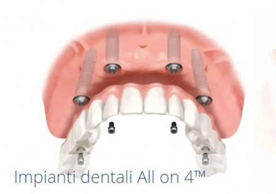 Sostituire i denti mancanti: la soluzione migliore