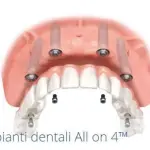 Sostituire i denti mancanti: la soluzione migliore