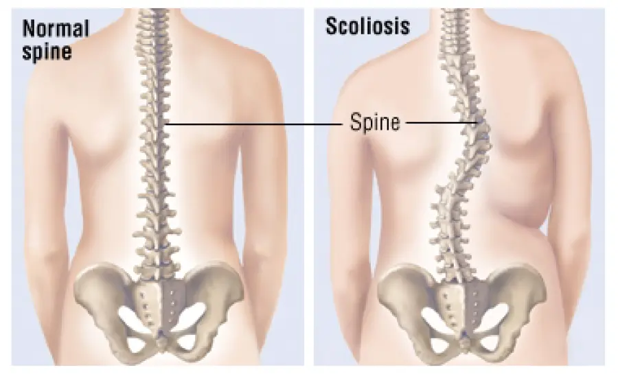 Scoliosi idiopatica e scoliosi congenita. Intervento chirurgico