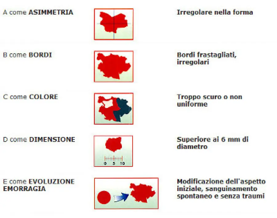 Caratteristiche neo sospetto da togliere
