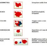 Caratteristiche neo sospetto da togliere