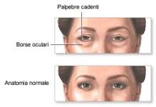 Blefaroplastica senza bisturi per palpebre pesanti