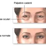 Blefaroplastica senza bisturi per palpebre pesanti