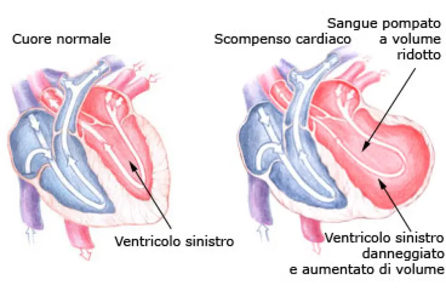Scompenso cardiaco: nuova cura con anello elastico