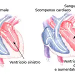 Scompenso cardiaco: nuova cura con anello elastico