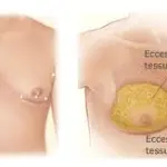 Ginecomastia maschile: cause aumento seno uomo