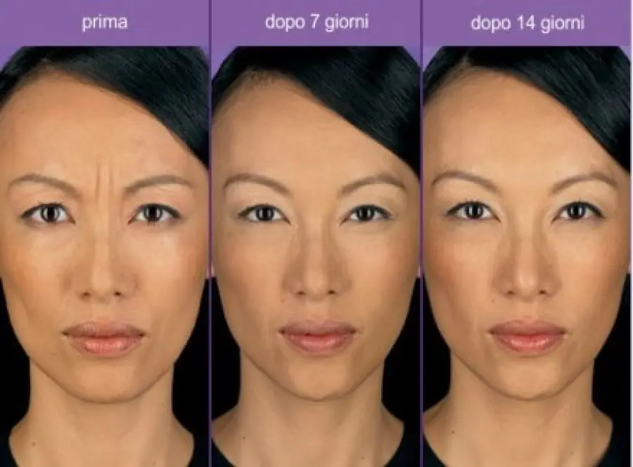 Botulino: rughe, sopracciglio, naso, mento, collo