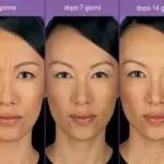 Botulino: rughe, sopracciglio, naso, mento, collo