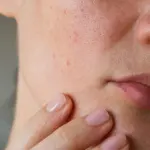 5 trattamenti casalinghi per la pelle grassa