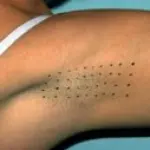 Botulino per iperidrosi: rimedio per eccessiva sudorazione di mani, piedi, ascelle, viso