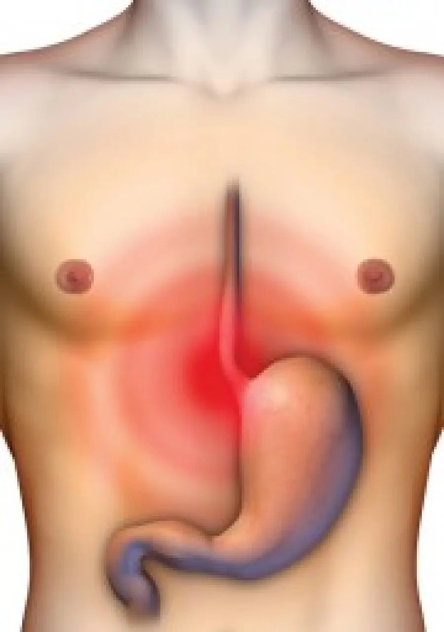 Difficoltà a digerire, bruciore di stomaco, gonfiore, nausea: sintomi dispepsia-Disturbo Gastrico