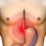 Difficoltà a digerire, bruciore di stomaco, gonfiore, nausea: sintomi dispepsia-Disturbo Gastrico