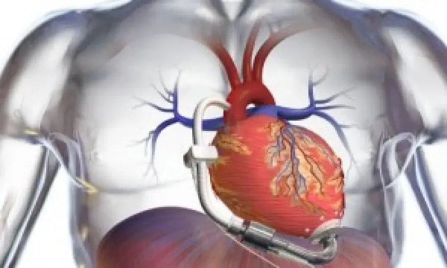 Vad: mini cuore artificiale. Intervento chirurgico per malati con grave scompenso cardiaco