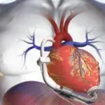 Vad: mini cuore artificiale. Intervento chirurgico per malati con grave scompenso cardiaco