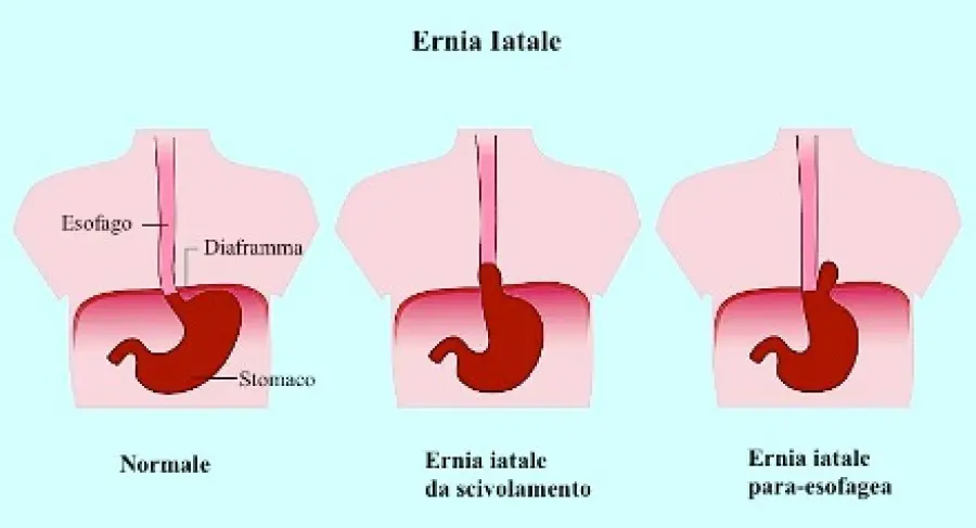 Ernia iatale con reflusso gastroesofageo: sintomi, diagnosi, cura, dieta per ernia iatale