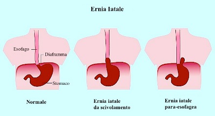 Ernia iatale con reflusso gastroesofageo: sintomi, diagnosi, cura, dieta per ernia iatale