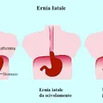 Ernia iatale con reflusso gastroesofageo: sintomi, diagnosi, cura, dieta per ernia iatale