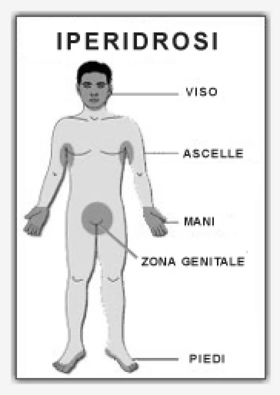 Iperidrosi-Cause sudorazione eccessiva: linfoma, ipertiroidismo, crisi ipoglicemica nei diabetici