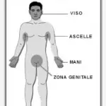Iperidrosi-Cause sudorazione eccessiva: linfoma, ipertiroidismo, crisi ipoglicemica nei diabetici