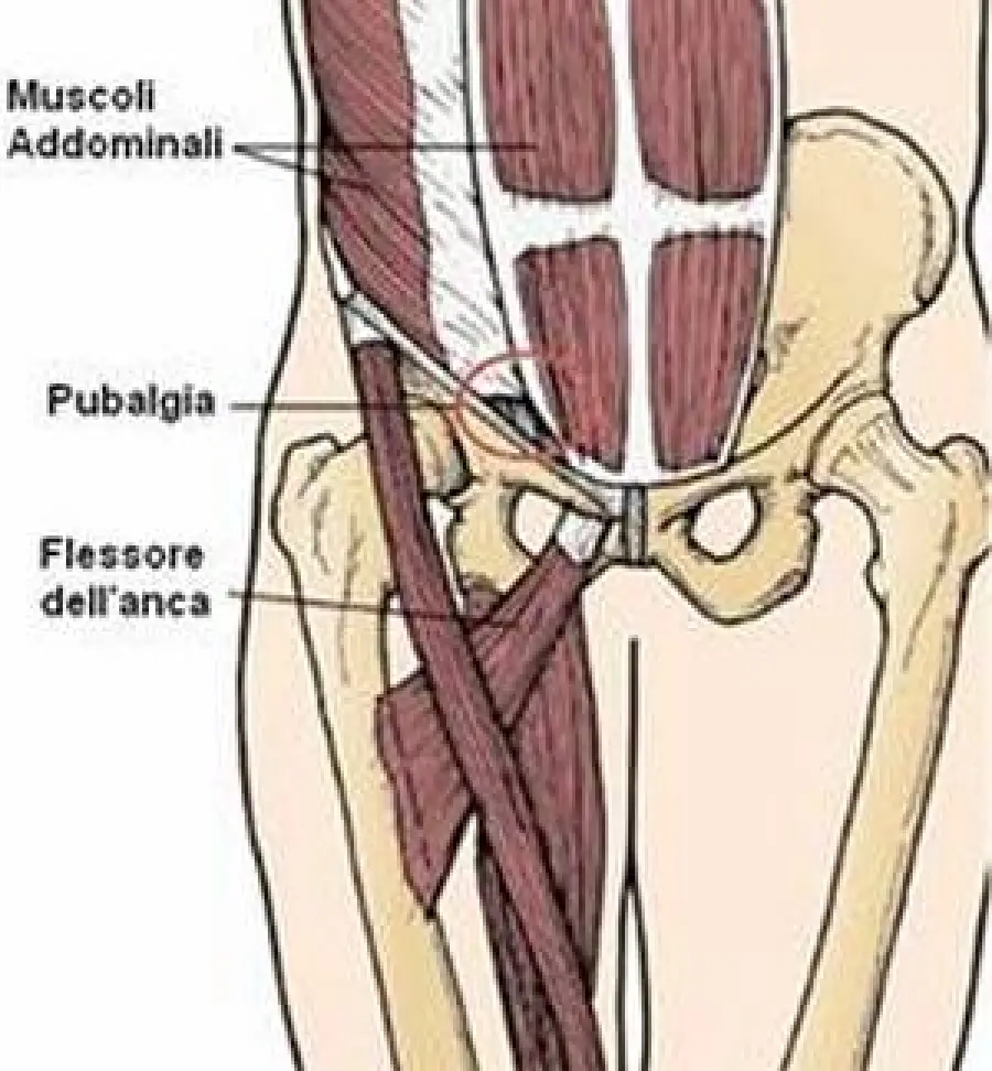 Cause pubalgia: sia sportivi, sia in gravidanza. Prevenzione, diagnosi, cure pubalgia cronica