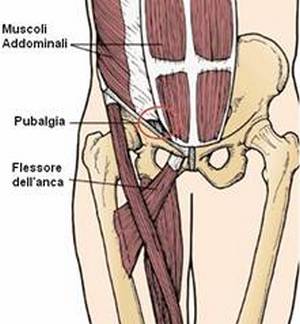 Cause pubalgia: sia sportivi, sia in gravidanza. Prevenzione, diagnosi, cure pubalgia cronica