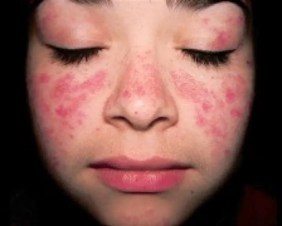 Sintomi lupus eritematoso sistemico: eritema, macchie violacee della pelle, fotosensibilità