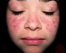 Sintomi lupus eritematoso sistemico: eritema, macchie violacee della pelle, fotosensibilità