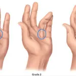 Malattia delle dita piegate: morbo di Dupuytren. Colpisce mani, piedi, pene nell' uomo