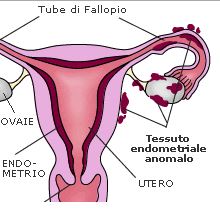 Mestruazioni dolorose ed endometriosi. Centri specializzati dove curare l' endometriosi