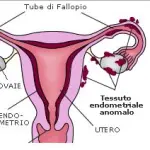 Mestruazioni dolorose ed endometriosi. Centri specializzati dove curare l' endometriosi
